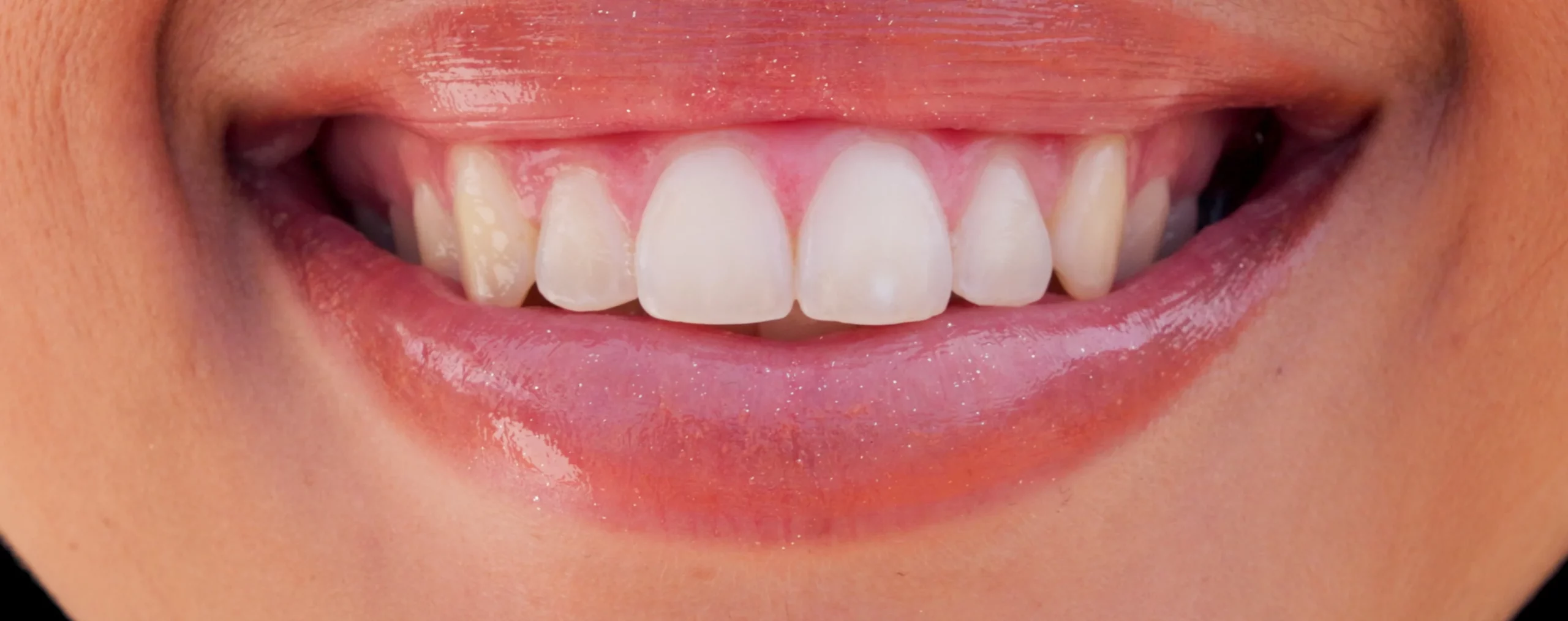 Veneers oder Zahnaufhellung – was ist die richtige Wahl?